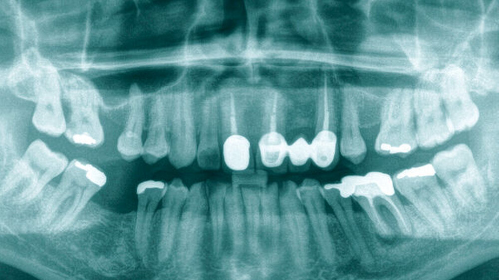 Abb. 1: Orthopantomogramm: Aufhellung Capitulum rechts (weißer Pfeil), nebenbefundlich rundliche Verschattung Sinus maxillaris links mit Verdacht auf Schleimhautretentionszyste