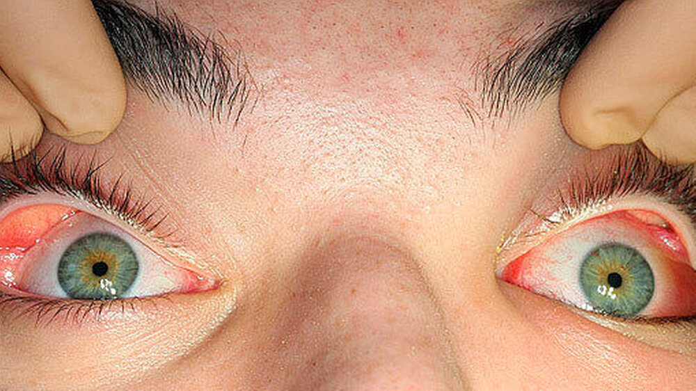 Abbildung 1: Klinischer Ausgangsbefund mit periorbitaler Schwellung links, Rötung, Chemosis, Exophthalmus und Bulbustiefstand Abbildung 1: Klinischer Ausgangsbefund mit periorbitaler Schwellung links, Rötung, Chemosis, Exophthalmus und Bulbustiefstand