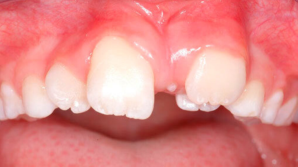 Abbildungen 16 und 17: Rotation und Lageverschiebung der Oberkieferschneidezähne sowie ein ausgeprägtes Diastema centrale aufgrund eines teils durchgebrochenen Mesiodens bei einem achtjährigen Patienten (16: frontale Ansicht). |