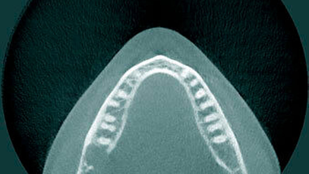 Abbildung 2: Präoperativer Befund im DVT mit Darstellung der Läsion in repräsentativer axialer Schicht. Erkennbar sind die mineralisierten Anteile sowie eine Auflösung der lingualen Lamelle. |