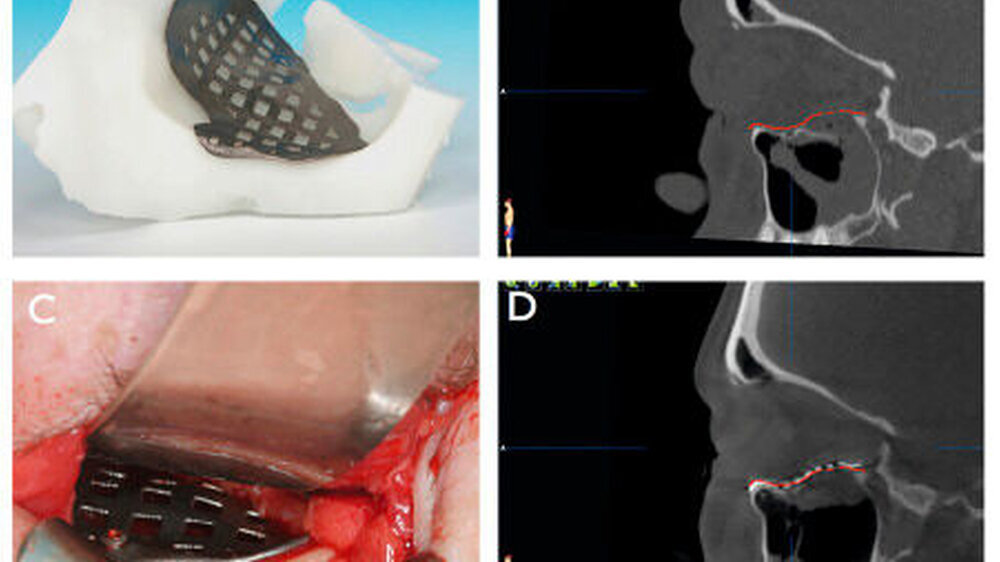 Abbildung 1: Laser-gesintertes patientenspezifisches Orbitaimplantat mit CAD-Modell (A); sagittale Ansicht einer komplexen Orbitamehrwandfraktur mit virtueller Planung des Implantats (rot) (B); transkonjunktival eingebrachtes Orbita-Implantat am Infraorbi Abbildung 1: Laser-gesintertes patientenspezifisches Orbitaimplantat mit CAD-Modell (A); sagittale Ansicht einer komplexen Orbitamehrwandfraktur mit virtueller Planung des Implantats (rot) (B); transkonjunktival eingebrachtes Orbita-Implantat am Infraorbitalrand, mit einer Schraube fixiert (C); sagittale Ansicht des Rekonstruktionsergebnisses der Orbitamehrwandfraktur mit virtueller Planung des Implantats (rot) (D) |