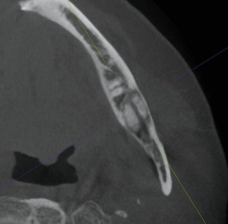 Das ossifizierende Fibrom – ein seltener, gutartiger Knochentumor im Kieferbereich - zm-online