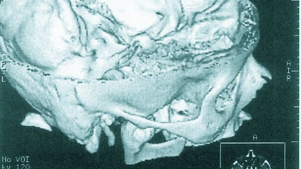 Abbildung 1: Das 3-D-CT zeigt eine ossäre Raumforderung, dem rechten Kiefergelenkköpfchen von ventral aufsitzend.