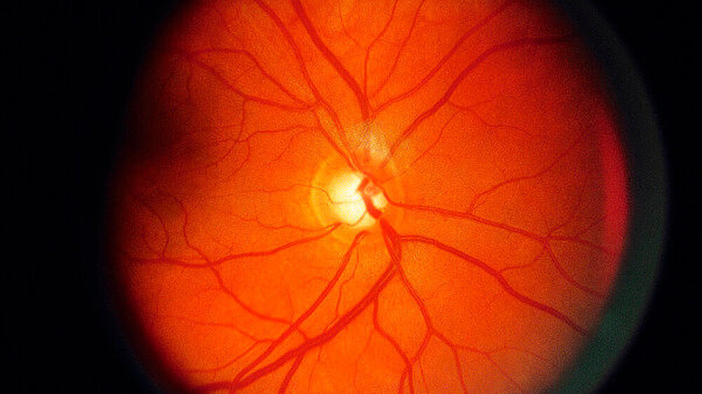 Erst mit einer Augenhintergrund-Spiegelung kann man ein Glaukom sicher diagnostizieren. Daher raten Augenärzte diese Untersuchung ab dem 40. Lebensjahr regelmäßig durchführen zu lassen. | Erst mit einer Augenhintergrund-Spiegelung kann man ein Glaukom sicher diagnostizieren. Daher raten Augenärzte diese Untersuchung ab dem 40. Lebensjahr regelmäßig durchführen zu lassen. |