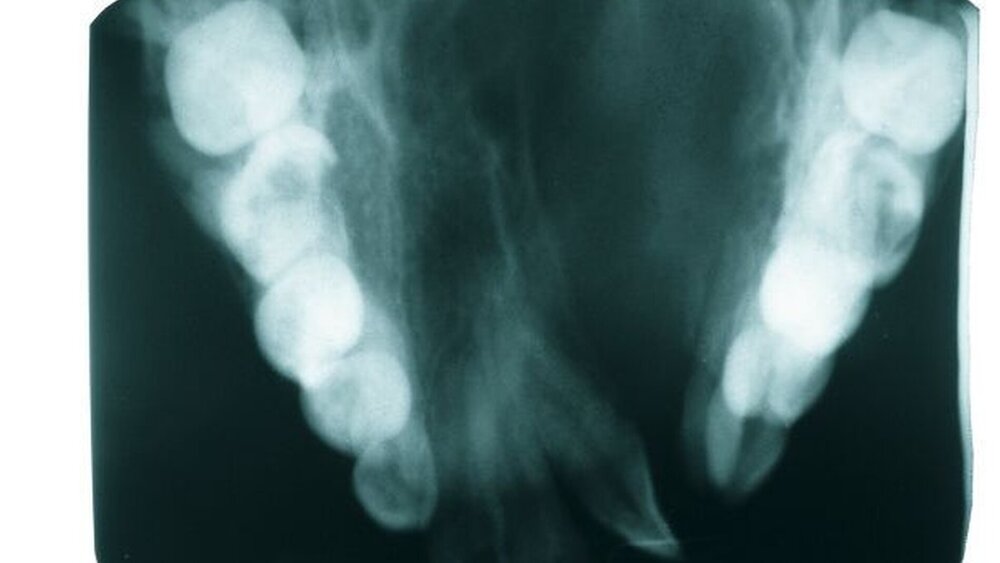 Abbildung 4: Die Aufbissaufnahme ergänzt den Befund des OPTGs als Nachweis für das Ausmaß der knöchernen Gaumenspalte. Es lassen sich ein größeres, rechtsseitiges und ein kleineres, links gelegenes Segment erkennen. |