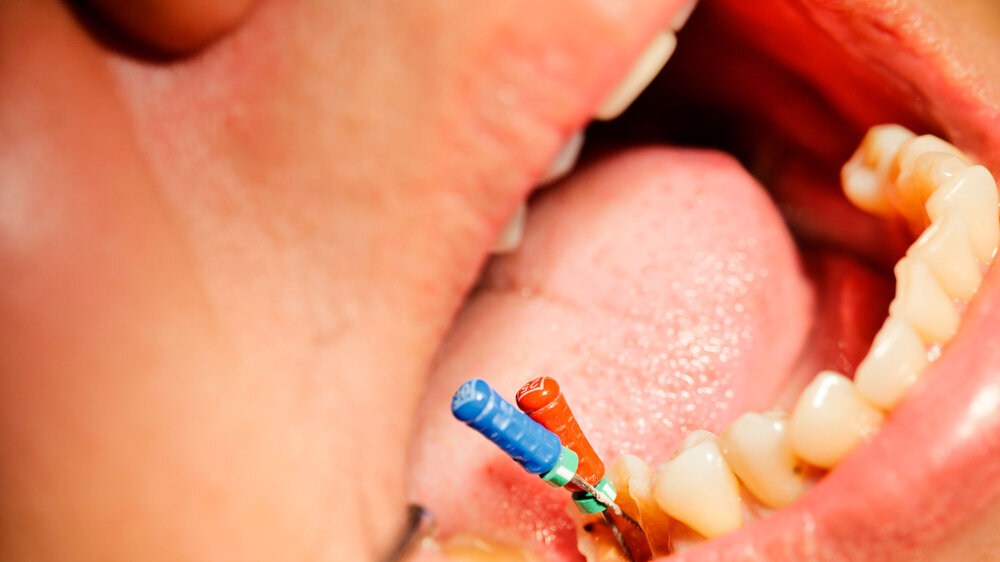 A patient undergoing root canal treatment on a molar tooth that has two roots.