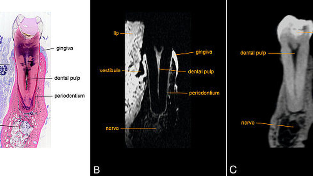 Histologischer Schnitt (A), MRT-Schnittbild (B) und DVT-Schnittbild (C) durch den zweiten Prämolaren im humanen Unterkieferpräparat: Im DVT sind weniger Strukturen erkennbar, als im MRT und in der Histologie. | Histologischer Schnitt (A), MRT-Schnittbild (B) und DVT-Schnittbild (C) durch den zweiten Prämolaren im humanen Unterkieferpräparat: Im DVT sind weniger Strukturen erkennbar, als im MRT und in der Histologie. |