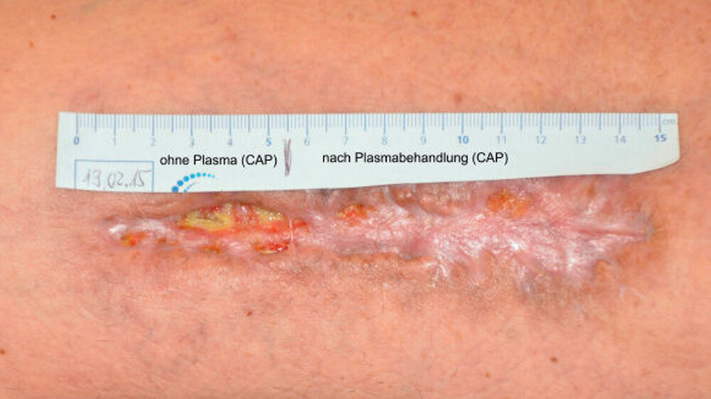 Infizierte Hautwunde - \r\nlinks: ohne Plasmabehandlung, rechts: Befund nach mehrmaliger Behandlung mit kalten Atmosphären-Druckplasmen (cold atmospheric plasmas, CAP)\r\n