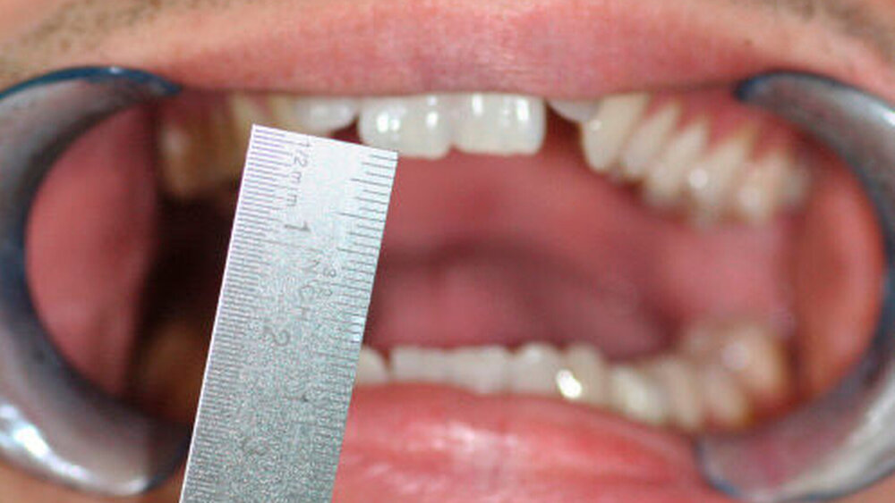 Abbildung 1: Klinisches Bild der eingeschränkten Mundöffnung (SKD 20mm) |