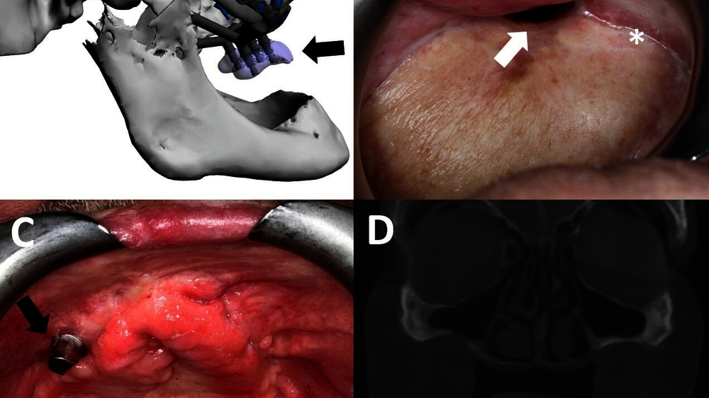 Abb. 1: Beispiele für Indikationen zur Versorgung mit Gerüstimplantaten: A und B zeigen die Planung eines IPS Implants® Preprosthetic (A) und die klinische intraorale Situation (B) nach postablativem Oberkieferdefekt bei einem Tumorpatienten; der schwarze Pfeil markiert die massive sagittale Diskrepanz der postablativen Pseudoklasse III. Bemerkenswert ist der transoral nach präaurikulär geführte Bügel mit Verankerung an der lateralen Schädelbasis rechts (A). Mit * ist in B der Übergang des mikrovaskulären Weichgewebetransplants zur Mundschleimhaut markiert, der weiße Pfeil zeigt eine persistierende oronasale Fistel. C stellt die intraorale Ausgangssituation bei einem älteren, multipel voroperierten LKG-Patienten dar. D zeigt das koronare Schnittbild aus einem DVT-Datensatz nach vorangegangenem Implantatverlust bei einem hoch atrophen Oberkiefer mit vollständig fehlenden Alveolarfortsätzen.