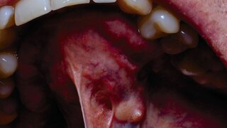 Ein Tumor in der Mundhöhle eines Erwachsenen