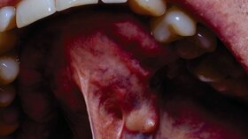 Ein Tumor in der Mundhöhle eines Erwachsenen