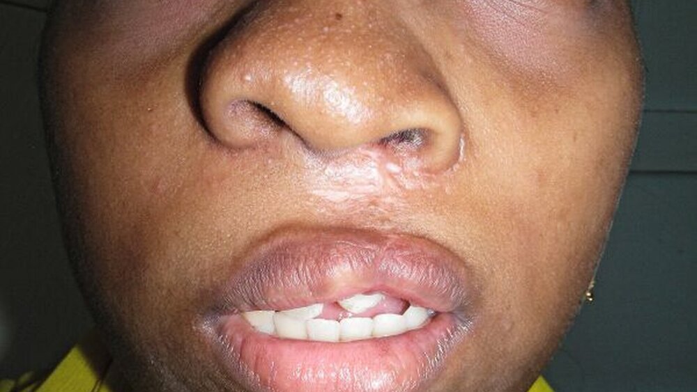 Abbildung 7: Frontalansicht der Patientin nach vertikaler Osteoplastik und Lippenrekonstruktion: Die Asymmetrie der Nase ist weniger ausgeprägt, jedoch nicht aufgehoben. Es zeigt sich ein suffizienter Lippenschluss. |