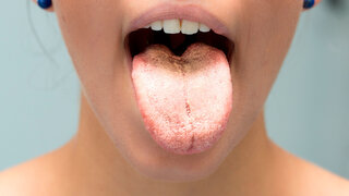 Infektion mit Candida albicans