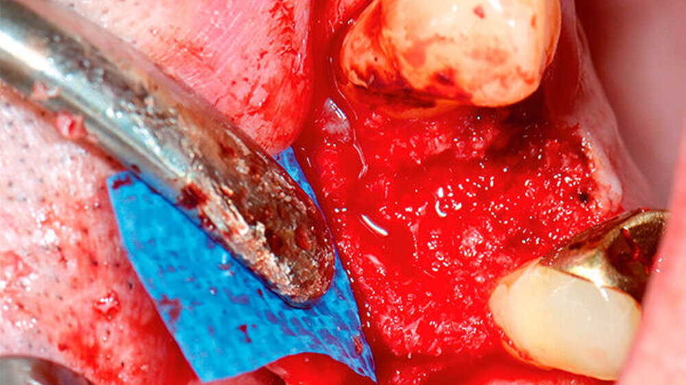 Auffüllung des Defekts regio 14 mit allogenem Knochenersatzmaterial (maxgraft spongiöse Granula, botiss biomaterials, Zossen, Deutschland)