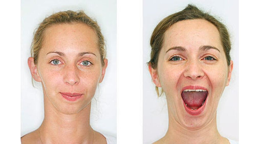 Die Patientin im Jahr 2014 (l.) mit Vogelgesicht und heute (r.): Drei Jahre nach der OP sind der Unterkieferrückbiss und der offene Biss sowie das fliehende Kinn dauerhaft beseitigt Die Patientin im Jahr 2014 (l.) mit Vogelgesicht und heute (r.): Drei Jahre nach der OP sind der Unterkieferrückbiss und der offene Biss sowie das fliehende Kinn dauerhaft beseitigt