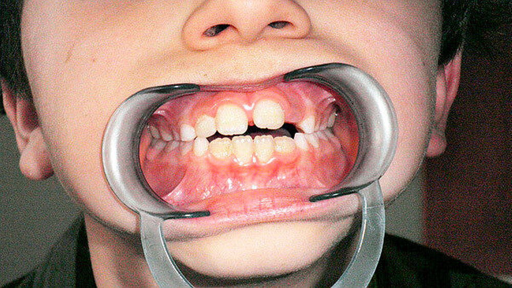 Abbildung 3: Der kleine Patient hatte einen geöffneten Biss, hervorgerufen durch einen Lutschhabitus, eine unphysiologische Zungenlage sowie ein unphysiologisches Schluckbewegungsmuster. |