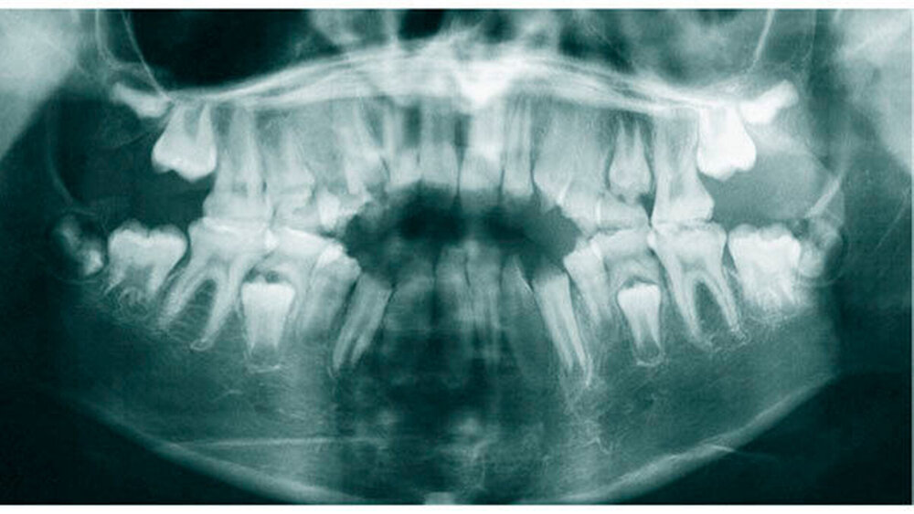 Abbildung 4: Das OPG zeigt die Dysplasie an beiden Dentitionen. |