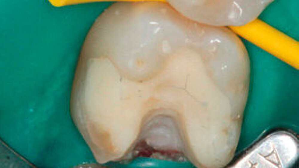 Abbildung 1: distal subgingival liegender Kavitätenrand mit Gingivaexposition