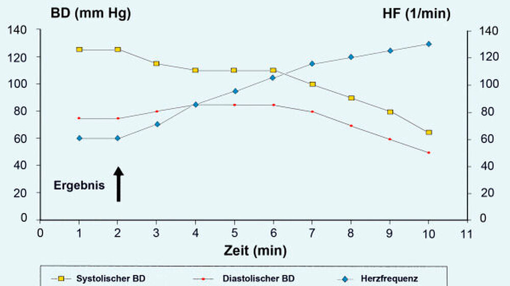 Diese Synkope ist gekennzeichnet durch einen gleichzeitigen Abfall von systolischem und diastolischem Blutdruck sowie einer Bradykardie. Die auslösende Ursache (Pfeil) ist meist in einer psychogenen Reaktion zu sehen. | Diese Synkope ist gekennzeichnet durch einen gleichzeitigen Abfall von systolischem und diastolischem Blutdruck sowie einer Bradykardie. Die auslösende Ursache (Pfeil) ist meist in einer psychogenen Reaktion zu sehen. |