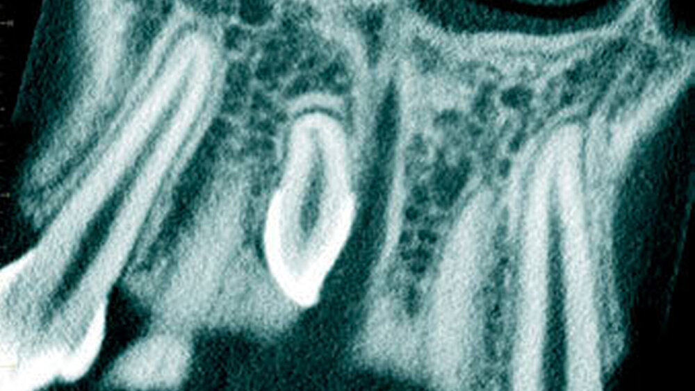 Abbildung 9: Überzähliger Zahn im Oberkieferfrontbereich (Mesiodens)mit einer konischen Form bei einem 14-Jährigen (a: koronales Schnittbild der digitalen Volumentomografie). |