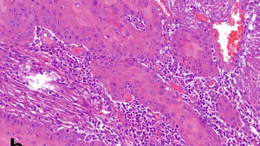 Abbildungen 3a und 3b: Histopathologischer Befund der Probebiopsie: unregelmäßiges Plattenepithel mit strukturellen und zellulären Atypien sowie flankierenden Epitheldysplasien; in Abbildung 3b erkennbares, lokal invasives Wachstum eines hoch differenzierten verhornenden Plattenepithelkarzinoms; deutliche entzündliche Überlagerung [Die histologischen Abbildungen wurden freundlicherweise von Dr. Andreas Wullbrand, Hamburg, angefertigt.] |