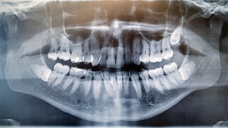 X ray
