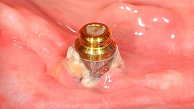Wie natürliche Zähne haben auch Implantate eine „harte“ Oberfläche auf der sich Biofilm ansammeln kann. Um Infektionsrisiken zu vermeiden, sollte vor dem Einsetzen von Implantaten kritisch beurteilt werden, ob eine entsprechende Mundhygiene sichergestellt ist.