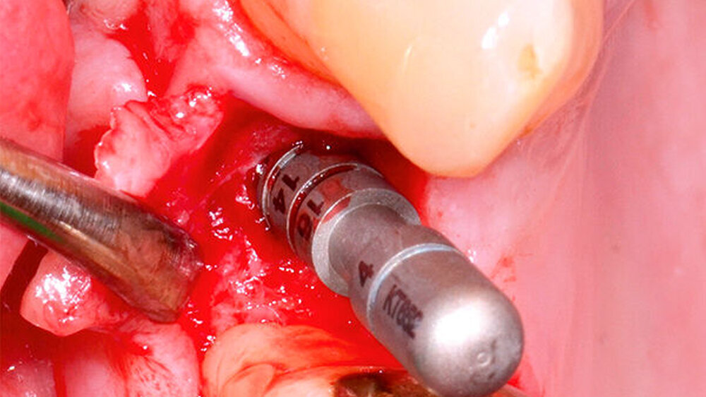 Re-entry nach sechs Monaten: erfolgreich gestaltetes Implantatbett