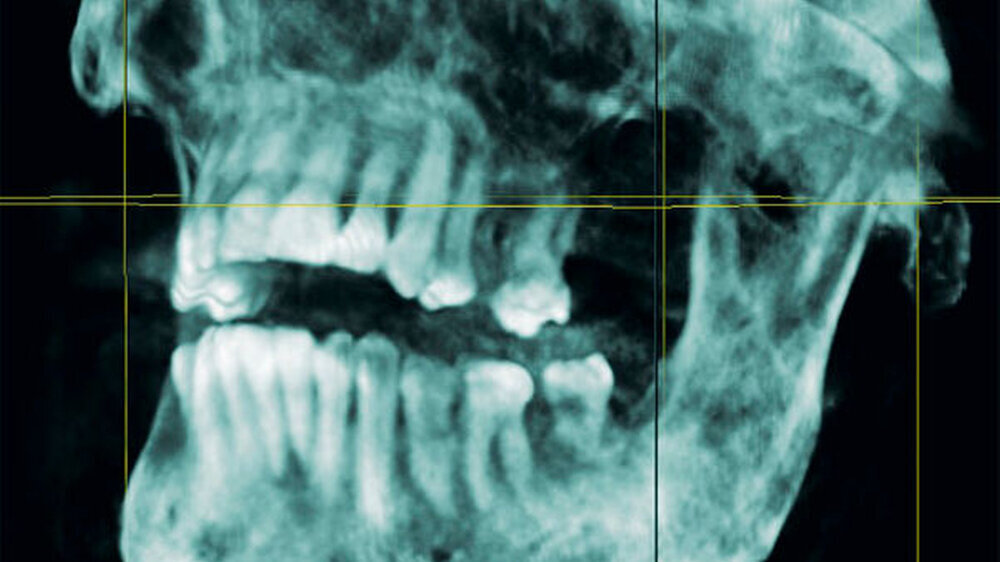 Dreidimensionale Übersichtsrekonstruktion der Digitalen Volumentomografie (DVT)