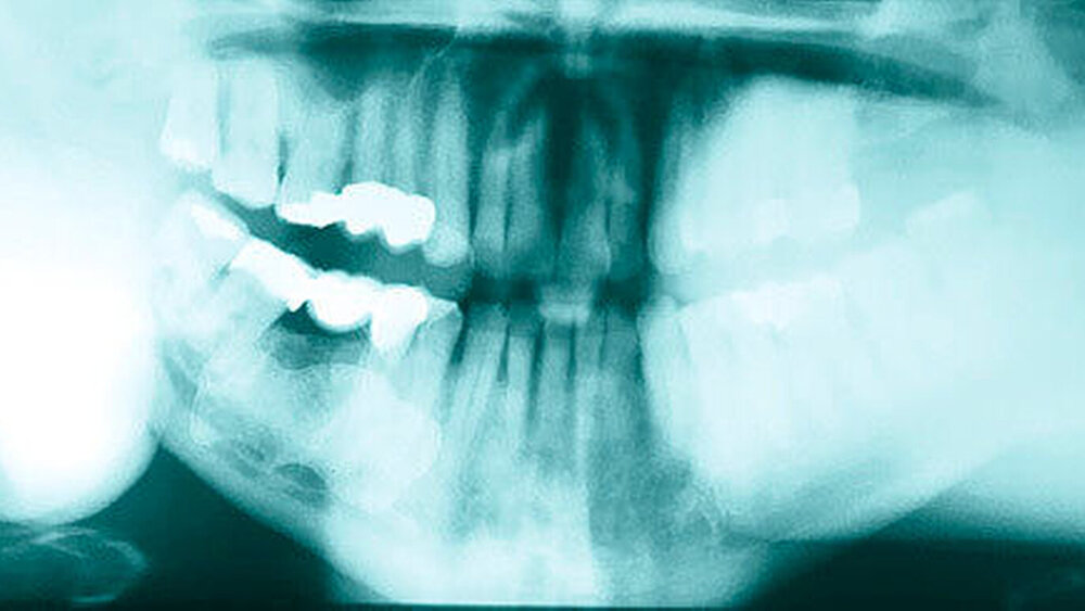 Abbildung 1: Orthopantomogramm mit ausgedehnter Verschattung im Bereich des rechten Kieferwinkels. |