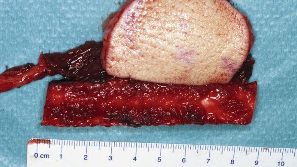 Abbildung 6: Osteomyokutanes Fibulatransplantat zur Deckung des Unterkieferdefekts. |