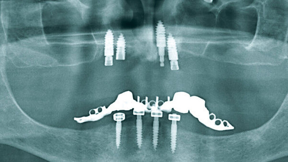 Abbildung 1: Präoperative Panoramaschichtaufnahme (PAN): Maxilla und Mandibula sind unbezahnt, beide Kiefer wurden mit jeweils vier Implantaten versorgt. Trotz lokalisierten periimplantären Knochenschwunds stellten sich diese klinisch reizlos dar. In de