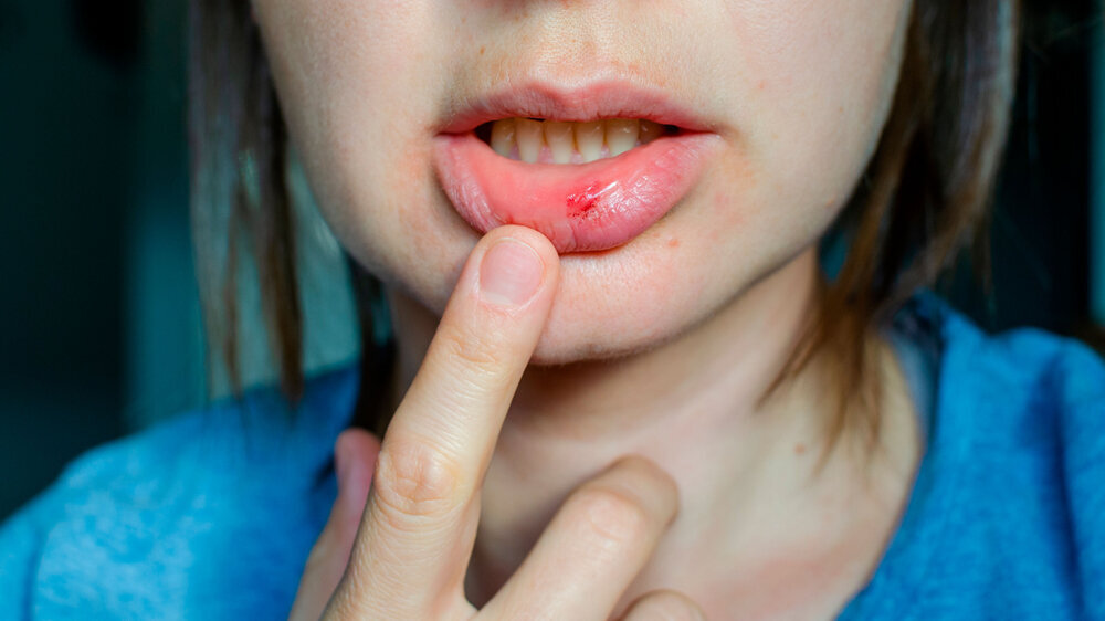 Nahaufnahme verletzte Lippe einer jungen Frau. Nahaufnahme verletzte Lippe einer jungen Frau.