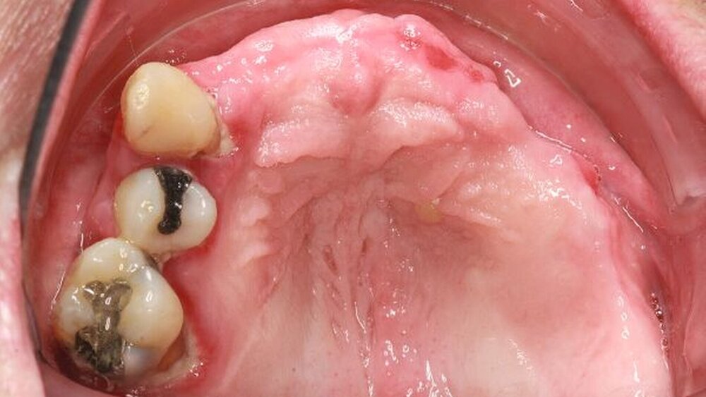 Abbildung 4: Unauffälliger klinischer Befund einer Wundheilung nach stattgefundener Extraktion und Biopsieentnahme in regio 23; nebenbefundlich Plaque und Gingivitis regio 13, 15 und 16 |