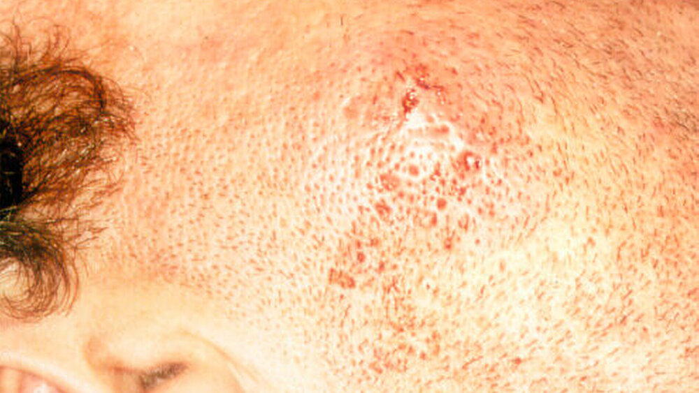 Abbildung 1a: Klinisches Bild einer seit fünf Tagen trotz systemischer Antibiose persistierenden Schwellung der rechten Wange |