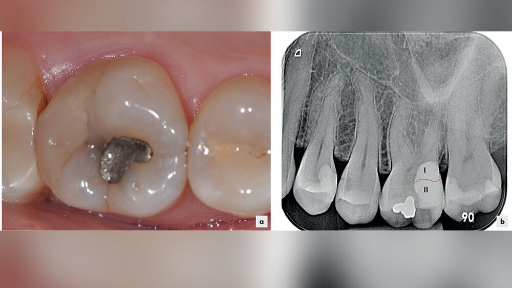 Abb. 1: a: Klinische Situation einer tief subgingivalen Restauration nach 9,5 Jahren: Es zeigen sich entzündungsfreie Verhältnisse von Gingiva und Parodont bei guter häuslicher Mundhygiene mit Nutzung von Interdentalraumbürstchen. Die Sondierungstiefe