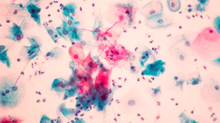 View in microscopic of Candidiasis, fungus infection (Yeast and Pseudohyphae form) in pap smear slide cytology and diagnostic by pathologist.Gynecology report and diagnosis.Sexually transmitted infect