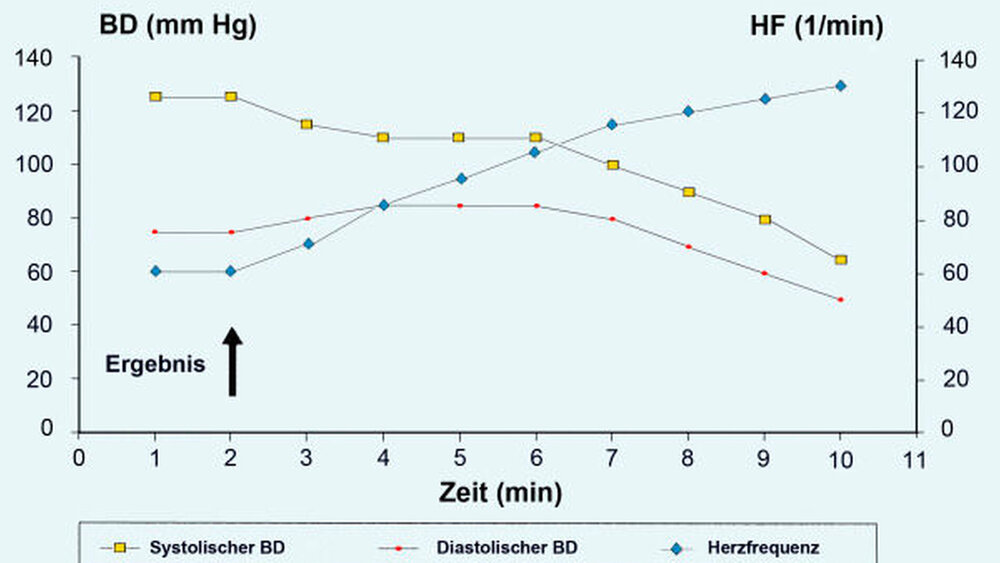 Diese Synkope ist gekennzeichnet durch einen gleichzeitigen Abfall von systolischem und diastolischem Blutdruck sowie einer Bradykardie. Die auslösende Ursache (Pfeil) ist meist in einer psychogenen Reaktion zu sehen. |
