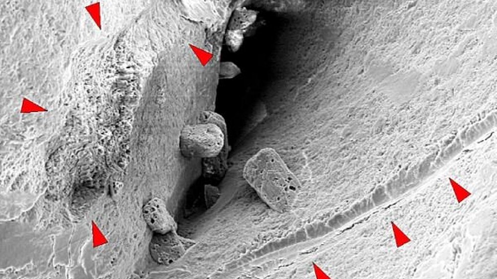 Abb. 1: Rasterelektronenmikroskopische Aufnahme einer initial kariösen Fissur nach zahnärztlicher Sondierung (150x). Am Fissurenfundus ist auf der rechten Bildseite eine deutliche Sondierungsspur und auf der linken Seite ein Schmelzabsprung sichtbar (ro
