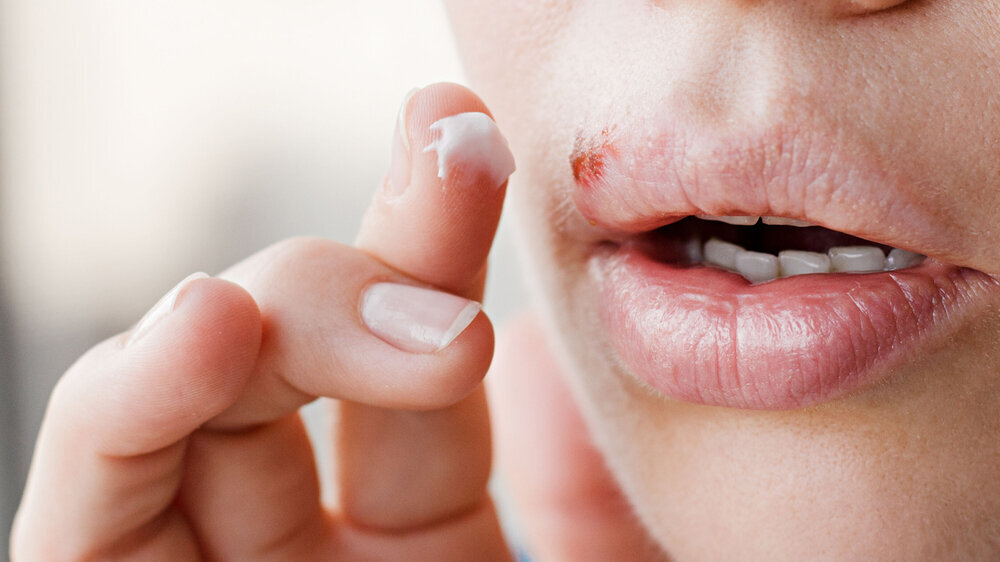 Eine Herpes-Enzephalitis wird durch eine Genmutation ausgelöst.