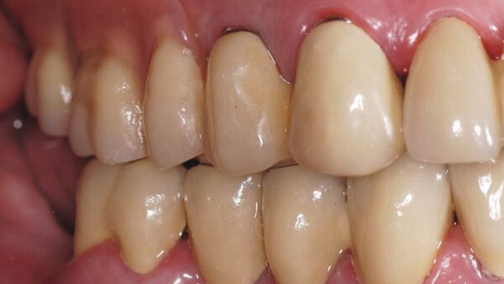 Abbildungen 16a, 16b, 16c, 16d, 16e: Abschlussbefund (definitiv befestigte Kronen und Brücken sowie eingegliederte partielle obere Prothese). |