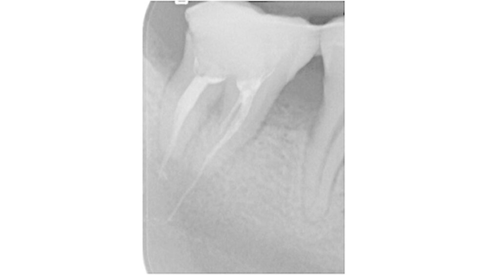 Abbildung 3: Zahnfilm zur verbesserten Darstellung der Pathologie im Unterkieferseitenzahnbereich |