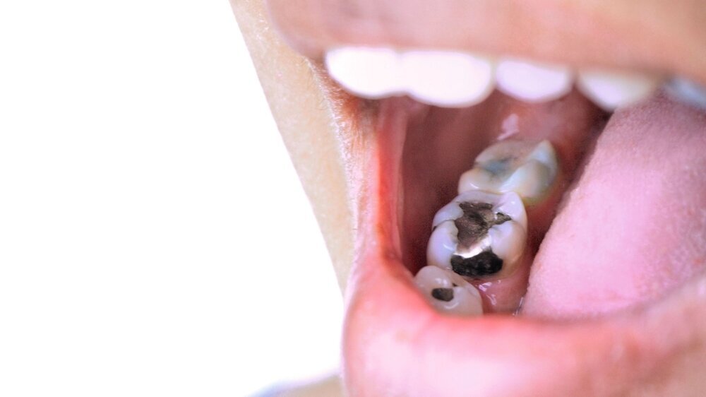 Oral health, tooth decay due to poor cleaning, treatment of tooth fillings. OLYMPUS DIGITAL CAMERA