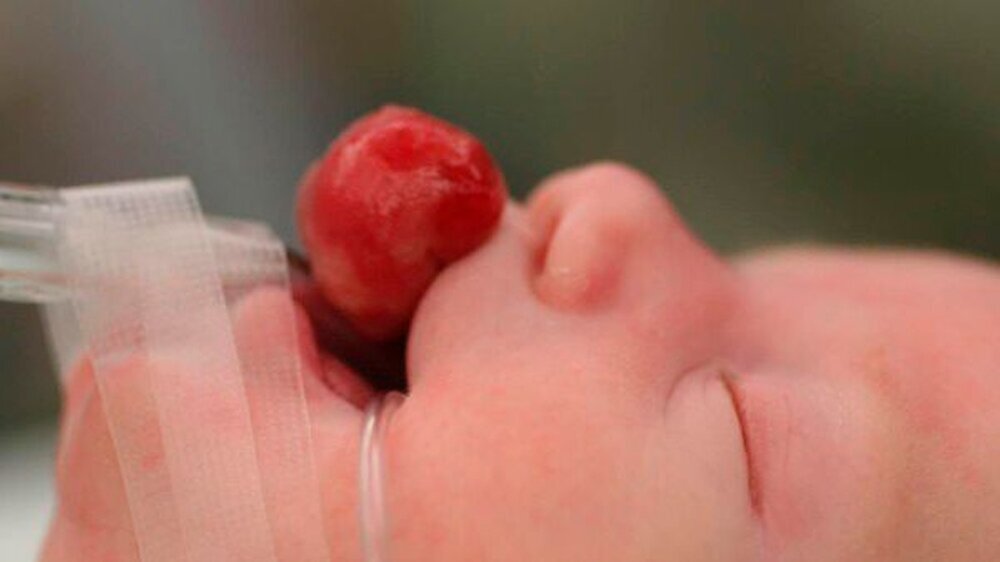 Abbildung 1: laterale Ansicht des exophytisch wachsenden Haupttumors