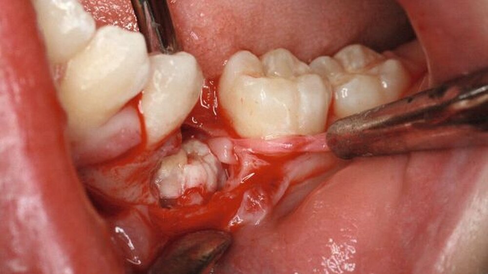 Abbildung 3: Odontom in situ: Odontom in situ nach Freilegung und partieller Entfernung der Gewebekapsel: Gut zu erkennen ist die Dicke der umgebenden Kapsel, was eine leichte Entfernung des Odontoms zulässt. |