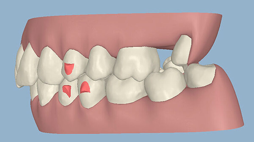 Abbildung 3b: Die Ausgangssituation im Clinical Check von Invisalign, seitlich links