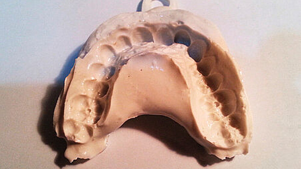 2. Zuerst nahm Dudley mithilfe „eines billigen Alginatpulvers“ einen Abdruck seiner Zähne und einen 3-D-Abdrucklöffel, um wie er schreibt „ein Bild davon zu bekommen, was wirklich los war“. Zu diesem Zeitpunkt, erzählt er weiter, „bin ich ein ’Undergrad’, was bedeutet, dass ich a) pleite bin und b) Zugang habe zu teuren digitalen Fertigungstools – eine ungewöhnliche Kombi“. |