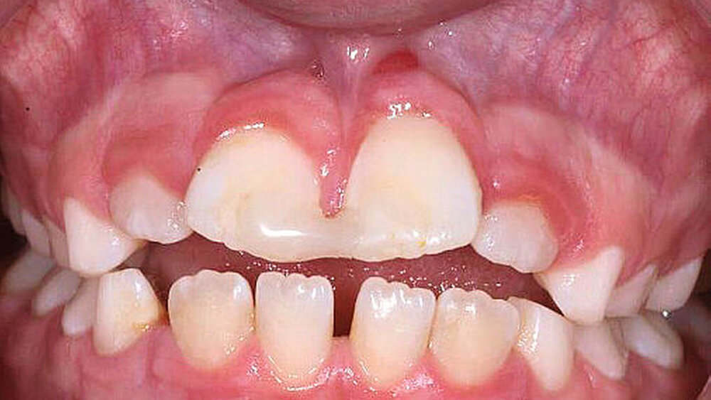 Abbildung 3: Zustand nach Avulsion und Replantation von Zahn 21 durch den Hauszahnarzt: Anamnestisch war zu erfahren, dass der Zahn 21 vor zwei Jahren replantiert worden war. Die extraorale Trockenlagerungszeit hatte etwa 60 Minuten betragen. Die Schienung erfolgte über zwei Jahre rigide durch eine Kunststoffschiene (a). Der klinische Befund zeigt eine apikale Rötung mit Fistel (a) sowie röntgenologisch eine entzündliche Resorption der gesamten Zahnwurzel (b). Außerdem zeigt sich eine diskrete vertikale Wachstumshemmung an Zahn 21 mit einem Weichgewebs-Minus von etwa 1,5 mm im Vergleich zum Nachbarzahn. Durch die rigide Fixierung wird der natürliche Durchbruch des gesunden Zahnes 11 behindert, was klinisch die Ausbildung des bereits sich abzeichnenden frontal offenen Bisses befördert. |