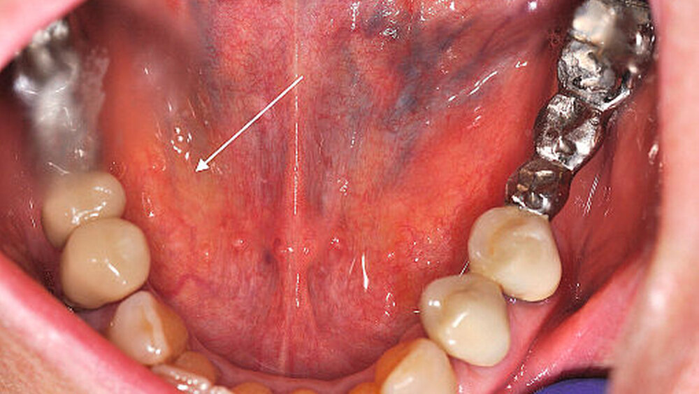 Abbildung 2:  Klinisches Bild der  intraoralen-sublingualen Patientensituation in kranio/kaudaler Richtung: prominente Vorwölbung im Bereich des rechten Mundbodens durch einen Speichelstein der Gl. subman-dibularis (mit weißem Pfeil markiert) |
